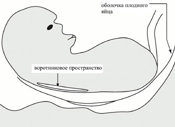 Комбинированный скрининг на синдром Дауна Комбинированный скрининг на синдром Дауна