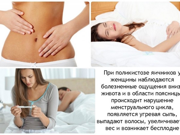 Симптомы поликистоза яичников Симптомы поликистоза яичников