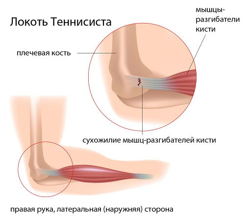 Эпикондилит Эпикондилит